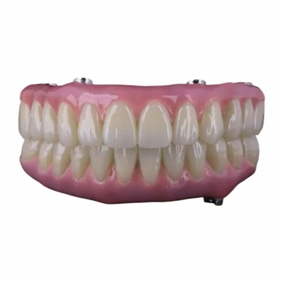 Titanium Hybrid Malo Bridge Full Mouth Implant