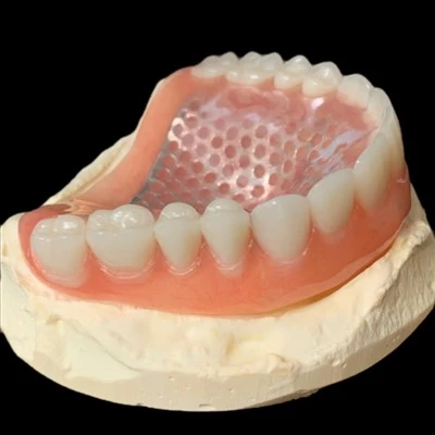 Upper Full Denture With Metal Mesh