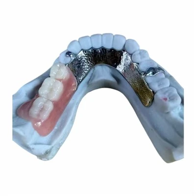 Vitallium Metal Framework and Partial Acrylic Denture