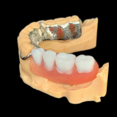 Vitallium Metal Framework With Denture