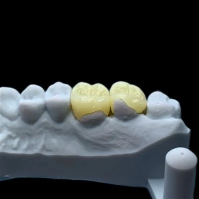 Zirconia Onlay
