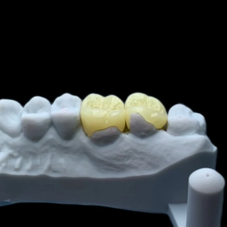 Zirconia Onlay
